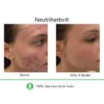 Neutriherbs Retinol Cream + Hyaluronic Acid Serum For Dry Skin - Image 5