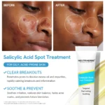 Salicylic Acid Spot Treatment for Acne & Blemishes - Image 5