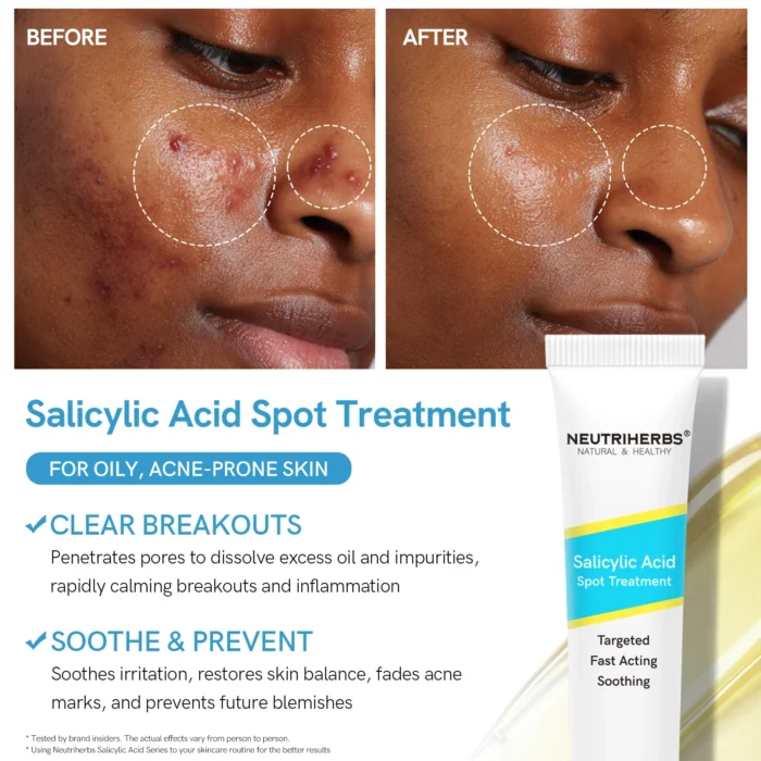 Salicylic Acid Spot Treatment for Acne & Blemishes - Image 5